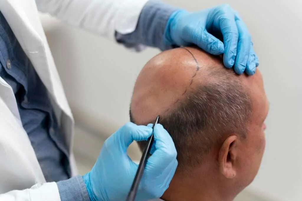 Doctor performing hair transplant procedure in Dubai clinic