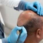 Doctor performing hair transplant procedure in Dubai clinic