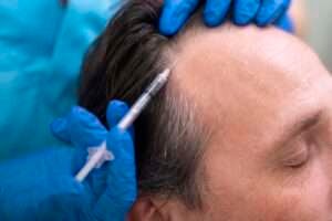 Best Hair Transplant in Dubai