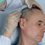 Best Hair Transplant Dubai