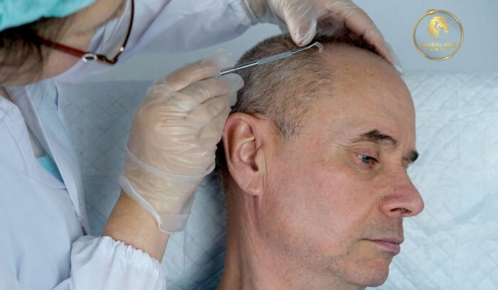 Best Hair Transplant Dubai