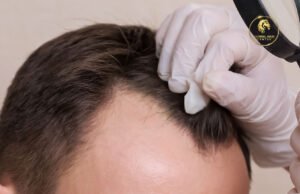 resume exercise after hair transplant