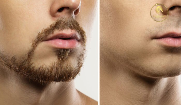 Beard Transplant Procedures