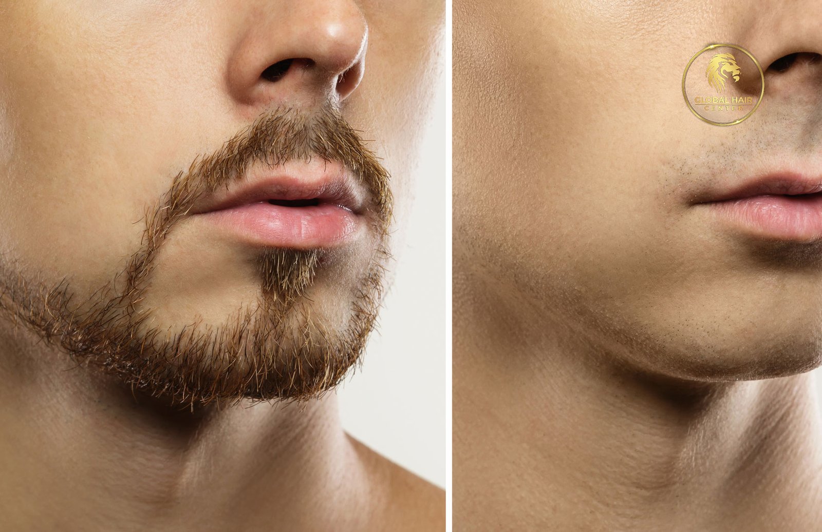 Beard Transplant Procedures