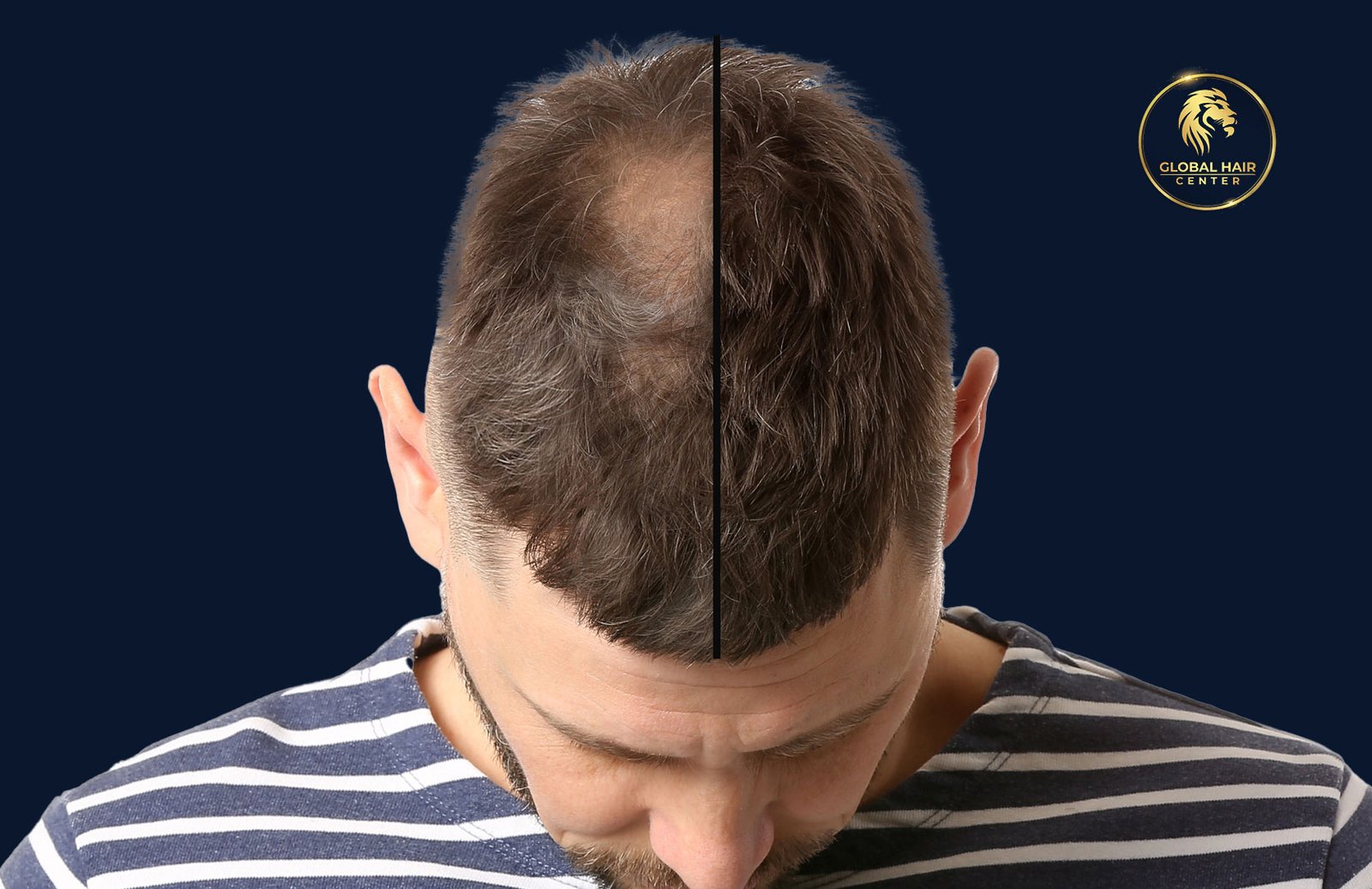 magic of Fue hair transplant in dubai