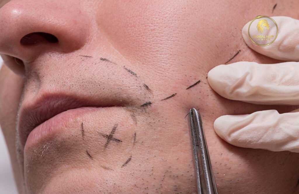 زراعة شعر الشارب: الحل الأمثل لتعزيز ثقة الرجال بأنفسهم
