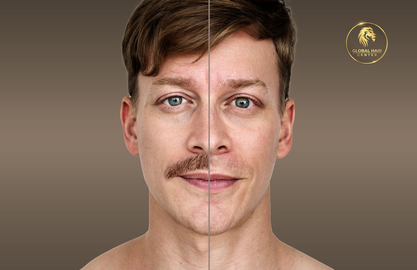 ultimate guide to mustache hair transplant