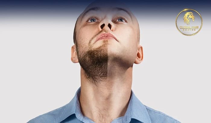 The Complete Guide To Beard Hair Transplant