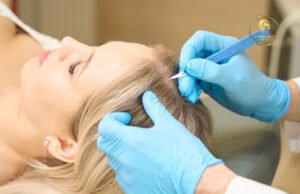 hair transplant