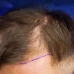 FUE Hair Transplant Cost In Dubai