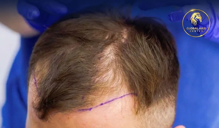 FUE Hair Transplant Cost In Dubai