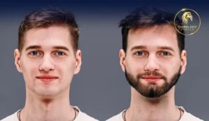 أفضل تكلفة زراعة الشعر
