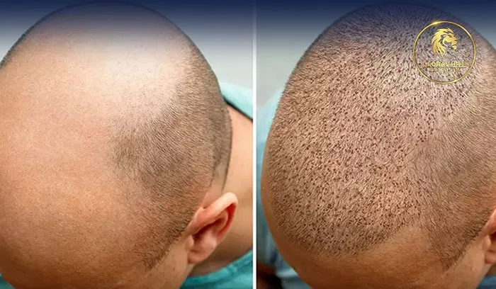 أفضل أطباء زراعة الشعر الموصى بهم في الإمارات داخل عيادة بتقييمات ممتازة.