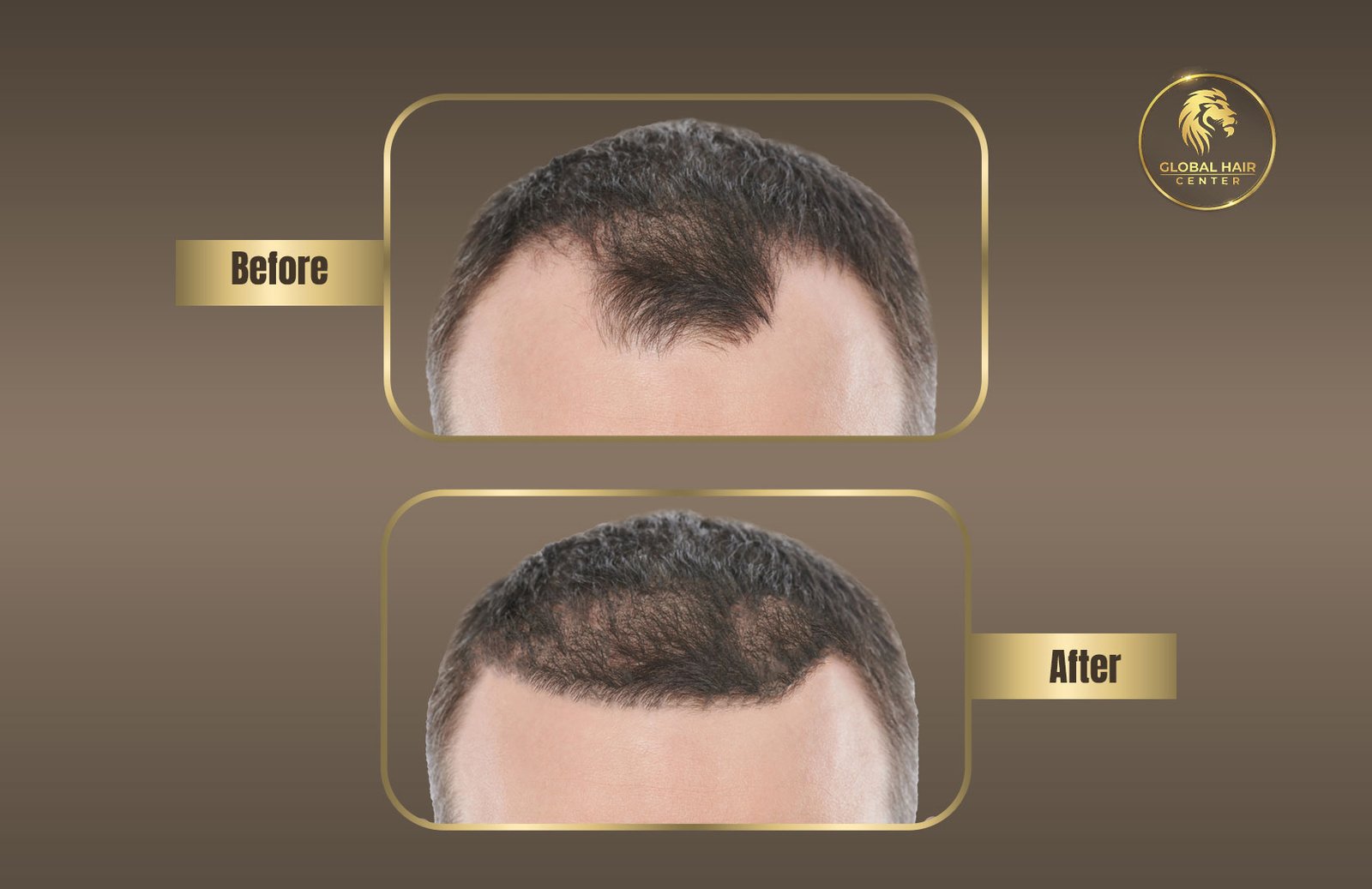 Transform Your Look: Discover the Key to Hair Transplant Success