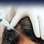 Natural Results For Hair Transplant in Dubai