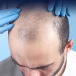 Advanced Hair Transplant Technology Cost in Dubai