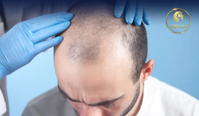 Advanced Hair Transplant Technology Cost in Dubai