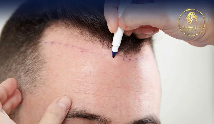 صورة توضح خدمات عيادة زراعة شعر بتقييمات ممتازة في الإمارات.