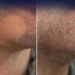 Beard Transplant in Dubai at Reasonable Cost