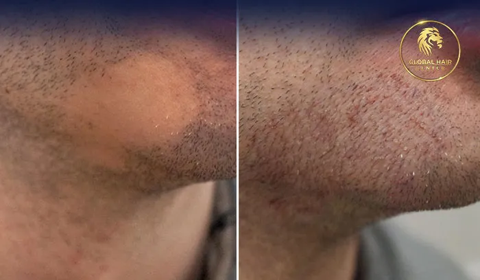 Beard Transplant in Dubai at Reasonable Cost