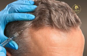 "Post-hair transplant scalp care routine in Dubai clinic"

