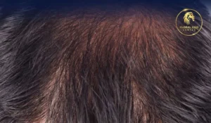 زراعة الشعر بتقنية الشريحة FUT في دبي للحصول على مظهر طبيعي ونتائج فعالة.