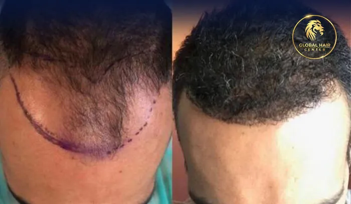 أفضل عيادة لزراعة الشعر في دبي تقدم خدمات متطورة ونتائج طبيعية.