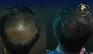 أفضل تكلفة لزراعة الشعر للنساء في دبي مع نتائج طبيعية وتقنيات متطورة