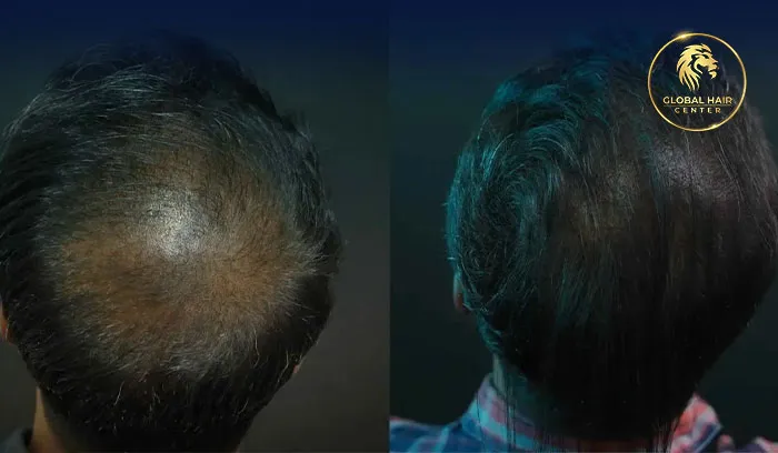 خدمة زراعة الشعر مع استشارة مجانية في دبي لتقديم حلول مخصصة ونتائج طبيعية.