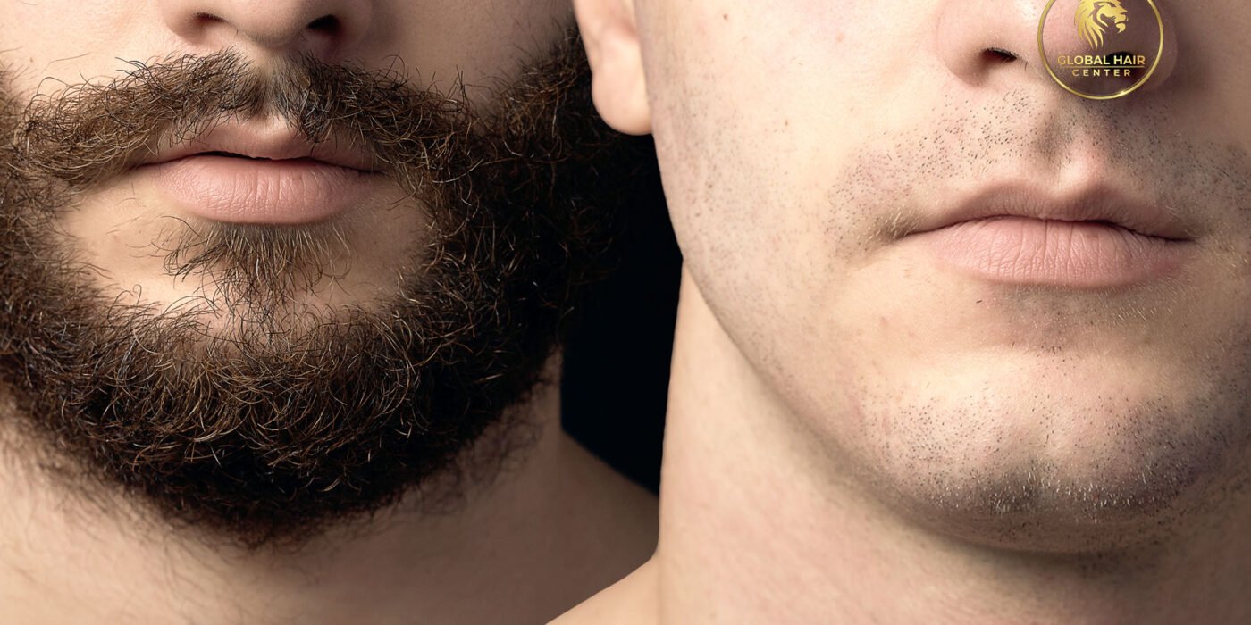 From Evaluation to Results: Understanding Mustache Hair Transplants