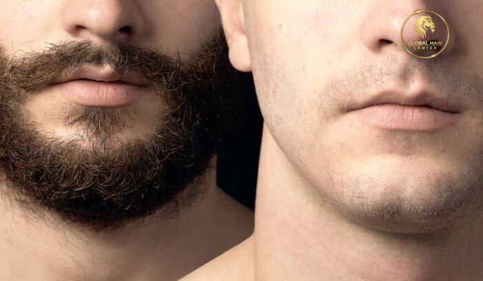 From Evaluation to Results: Understanding Mustache Hair Transplants