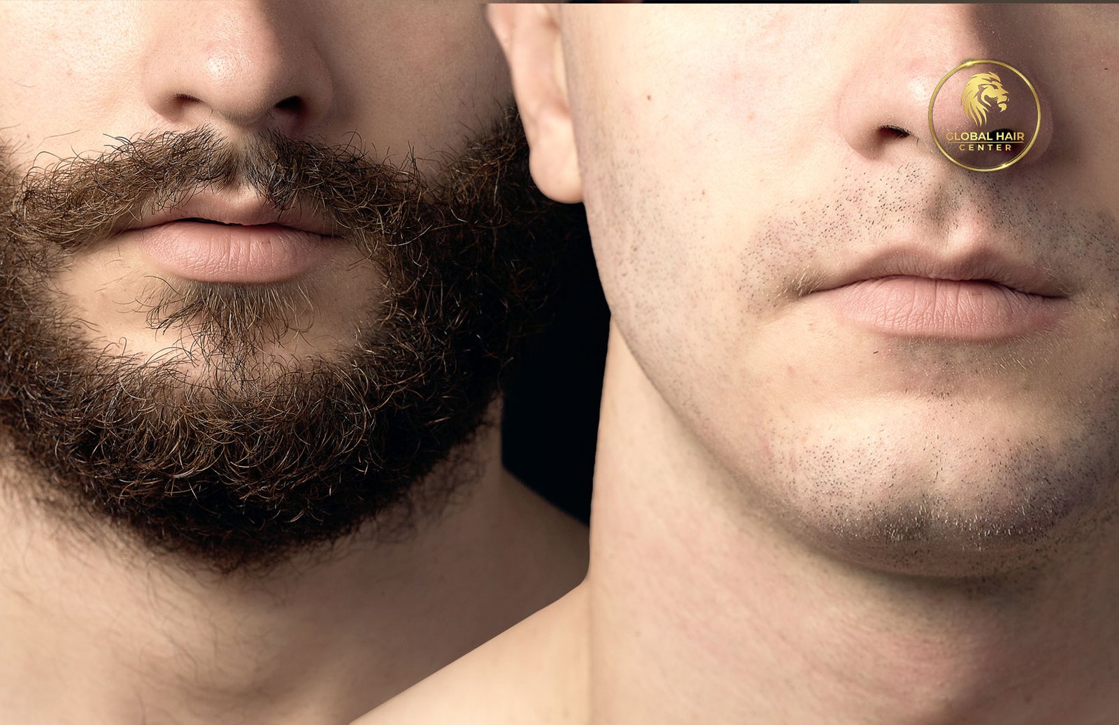 From Evaluation to Results: Understanding Mustache Hair Transplants