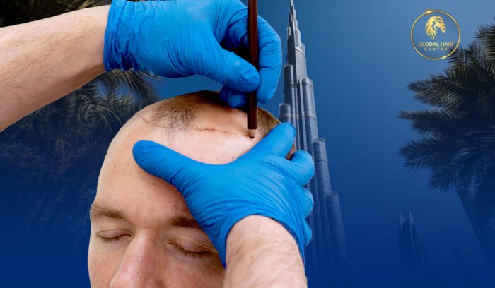 Hair Transplant Dubai 2025