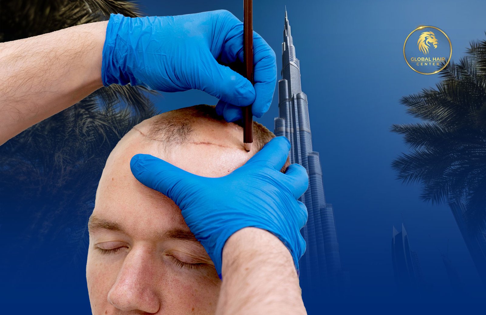 Hair Transplant Dubai 2025