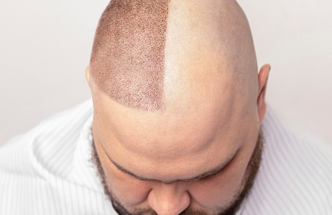 Hair transplant procedure in Dubai clinic