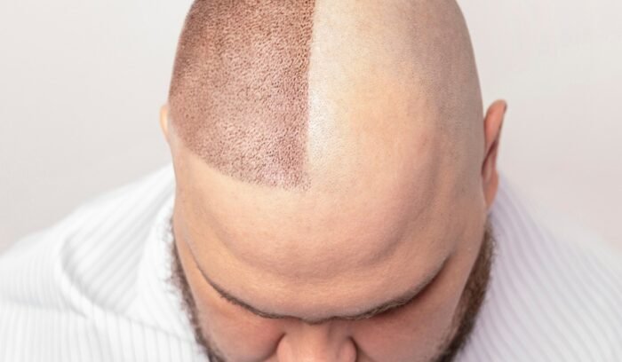 hair transplant surgery-aftre-befor