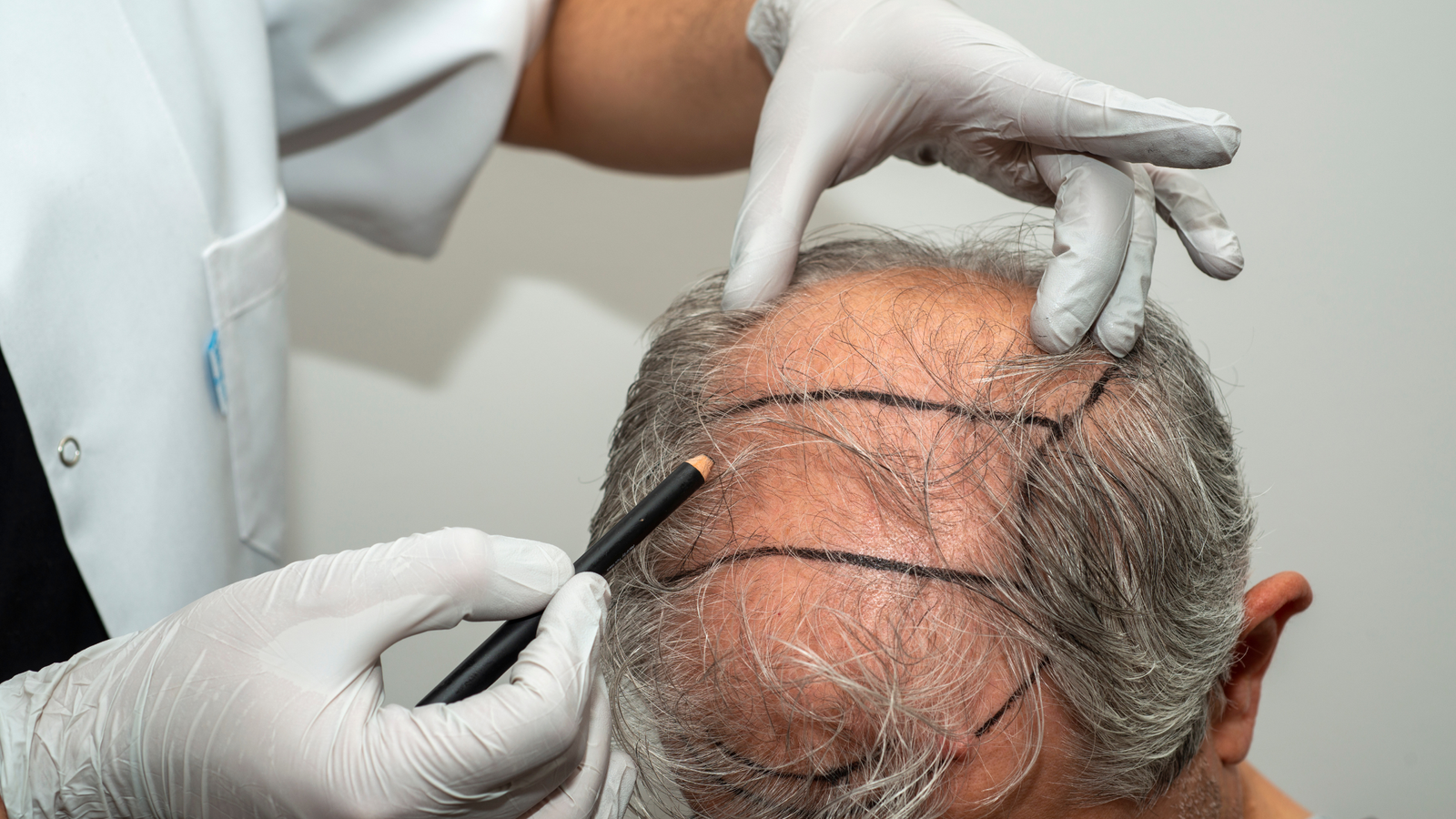 DHI Hair Transplant Dubai