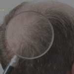 Top Hair Transplant Clinics Dubai