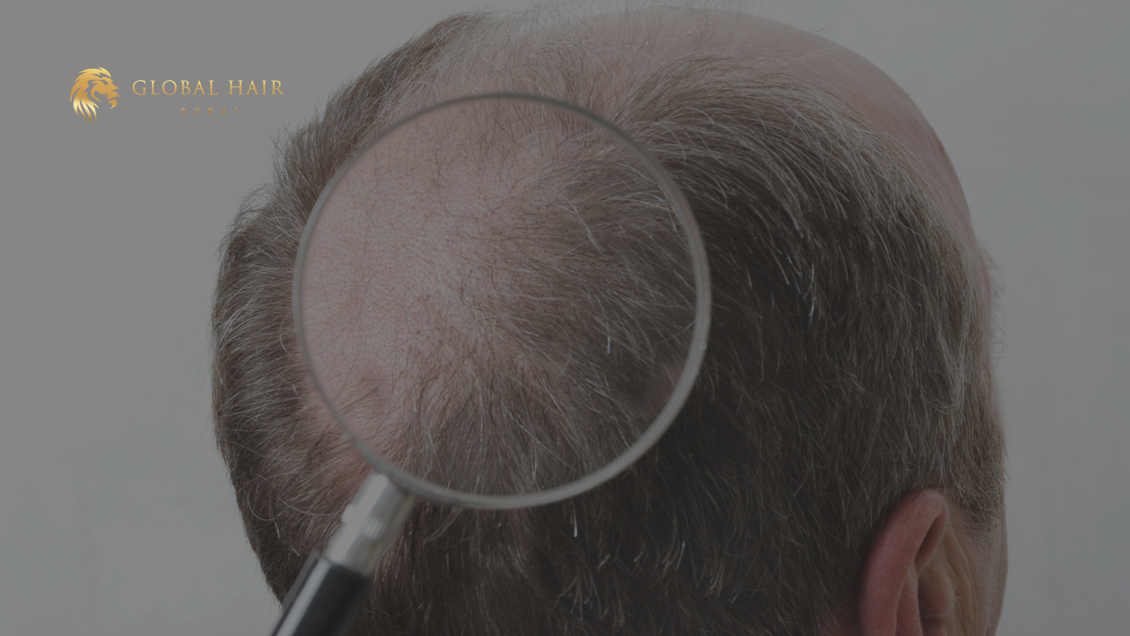 Top Hair Transplant Clinics Dubai