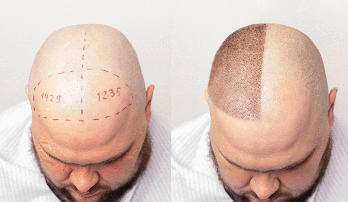 Permanent Hair Transplant Dubai