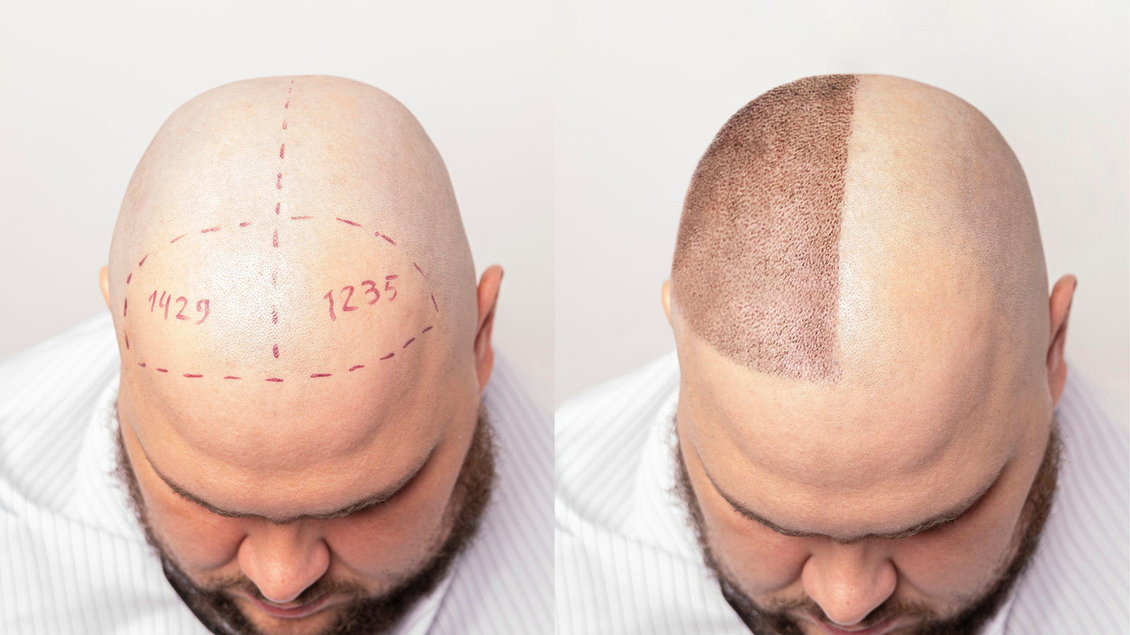 Permanent Hair Transplant Dubai