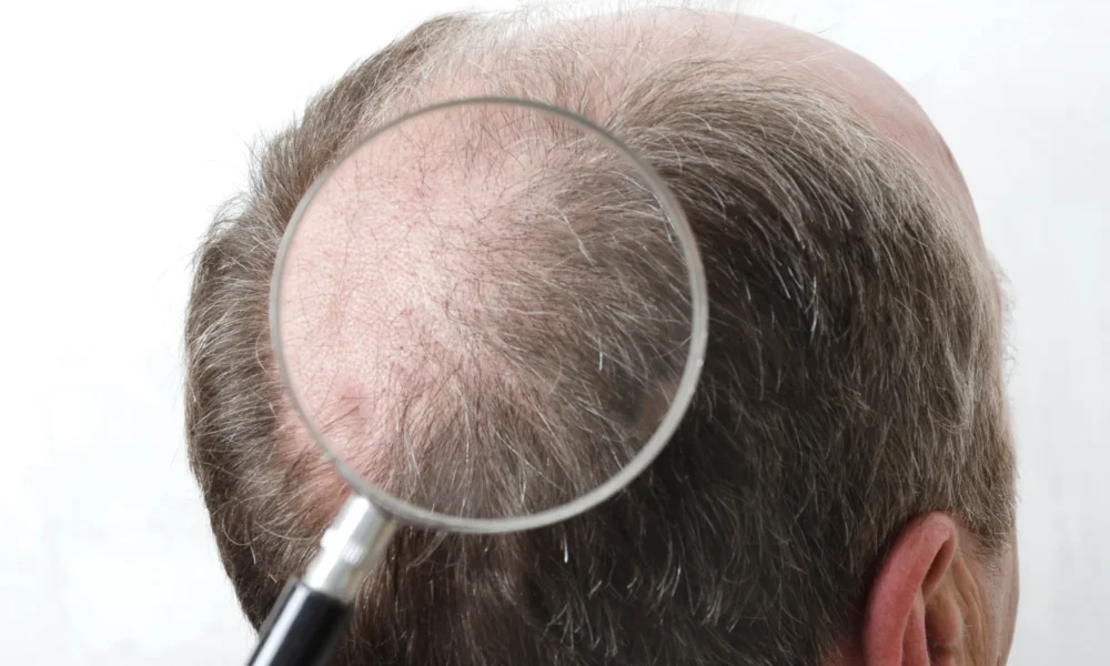 Best Hair Transplant Clinic in Dubai