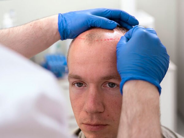 Head-Hair-Transplant