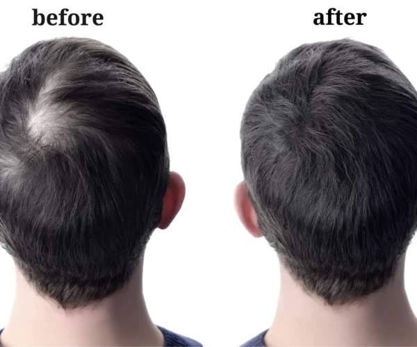 Best Hair Transplant Clinic in Dubai