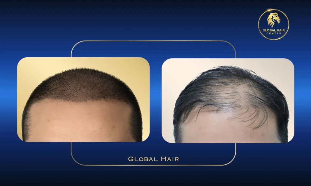 hair transplant before and after Dubai