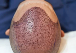 PRP Hair Treatment in Dubai: A Natural Solution for Hair Restoration