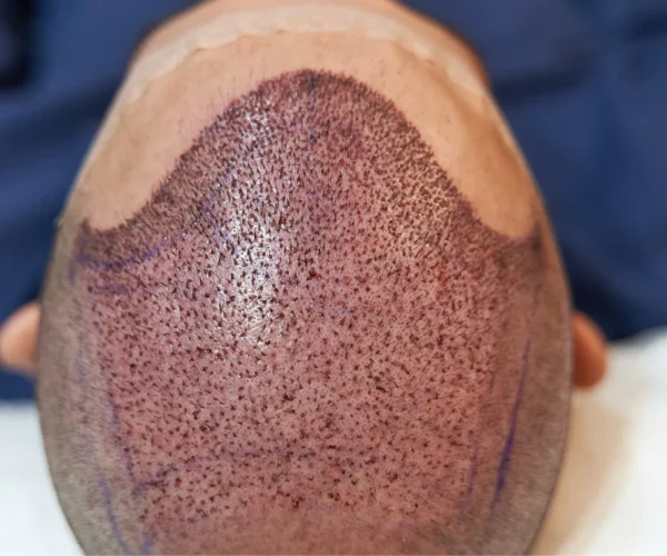 PRP Hair Treatment in Dubai: A Natural Solution for Hair Restoration