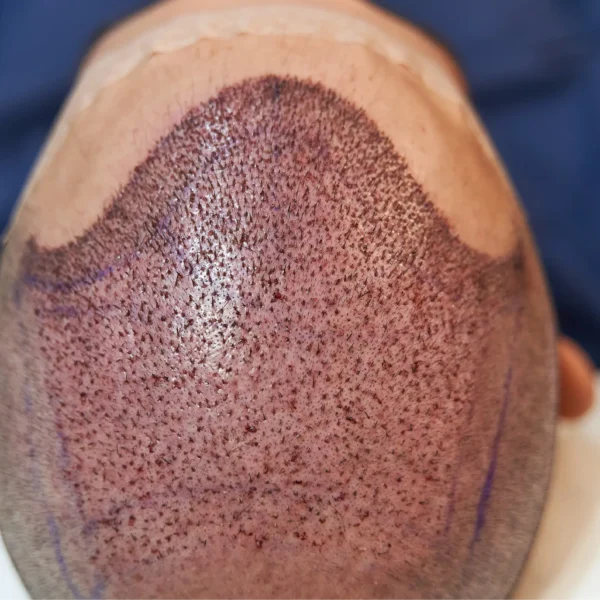 PRP Hair Treatment in Dubai: A Natural Solution for Hair Restoration