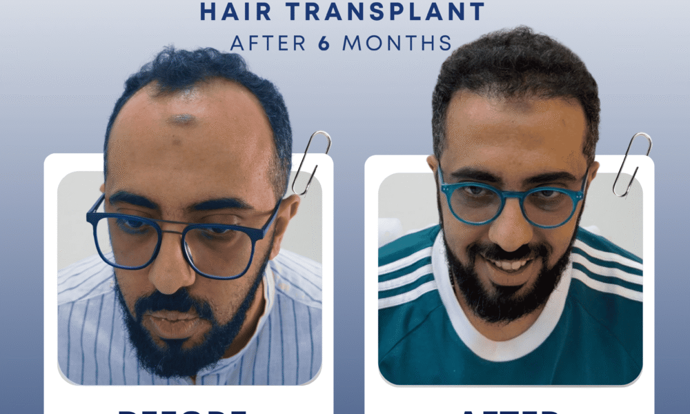 after / before hair transplant in dubai