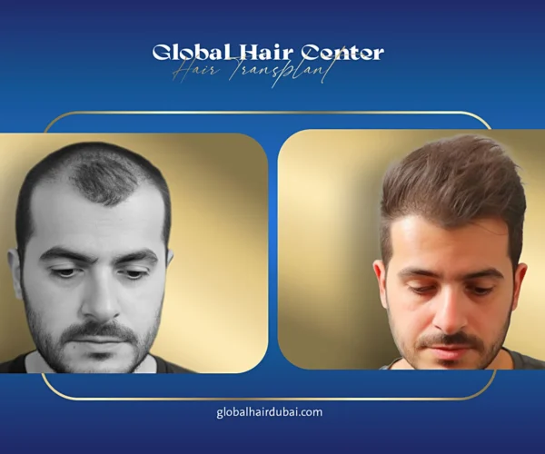 نتائج زراعة الشعر في دبي